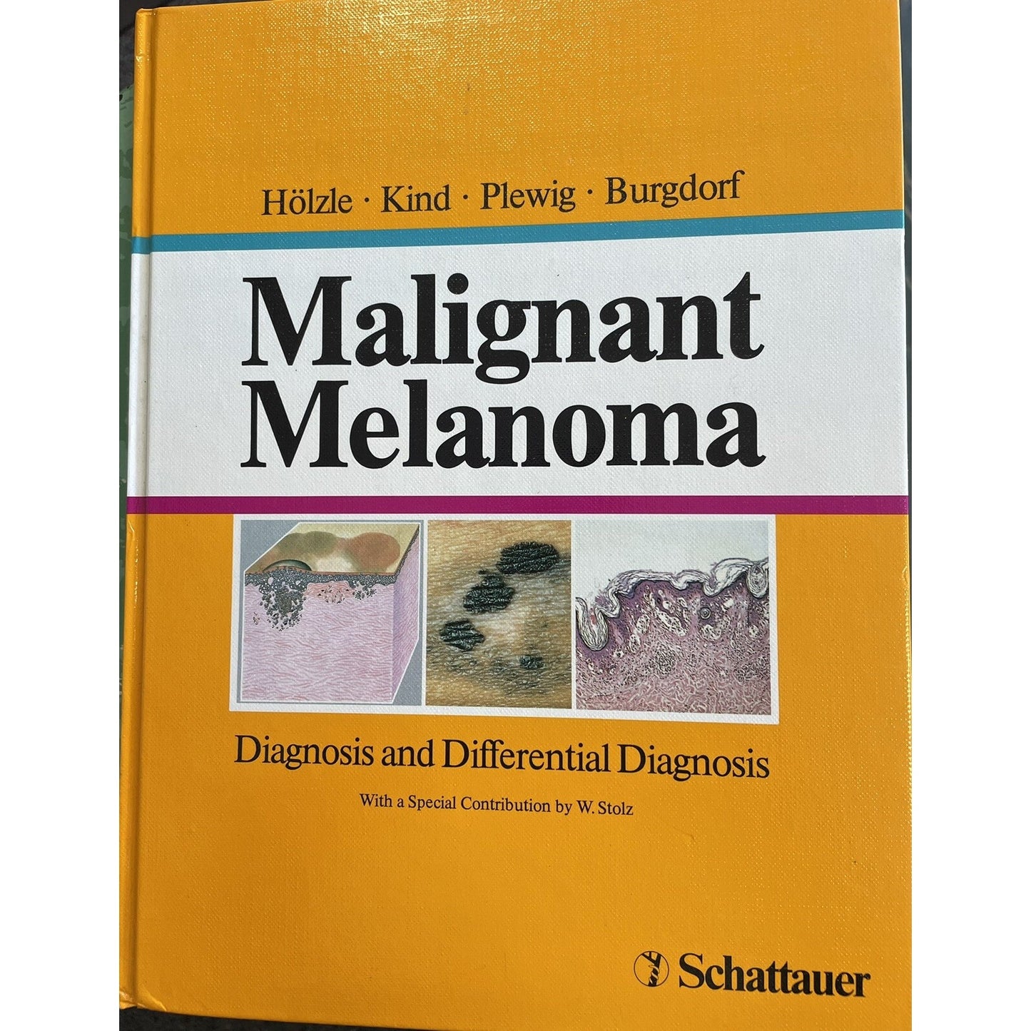 Malignant Melanoma Diagnosis & Differential Holzle Kind Plewig Burgdorf 1993 HC